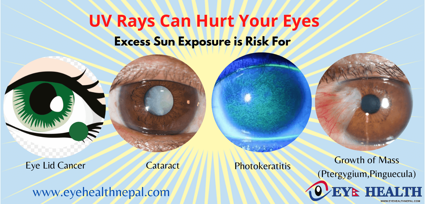 Midtown Optometry - Ultraviolet Light and How it Affects Your Eyes