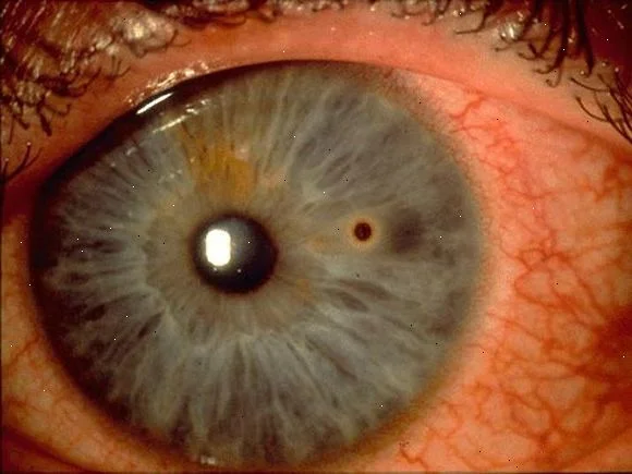 Metallic foreign body with rust ring in Cornea.