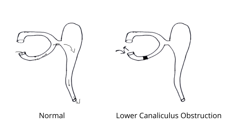 Normal-canaliculus-block in syringing