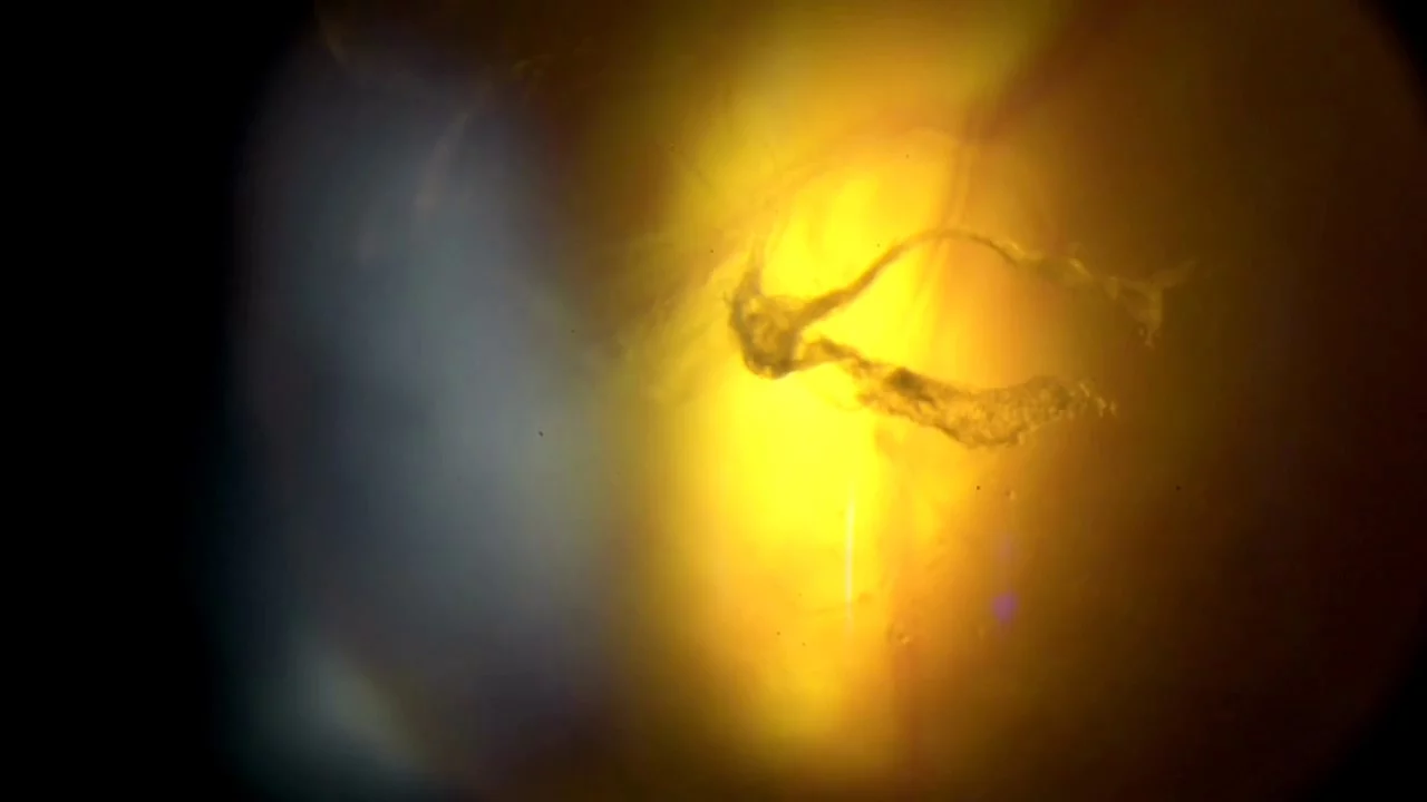 Images For Fmge Dec 2020 PDF | PDF | Glaucoma | Cataract, image size:1280x720