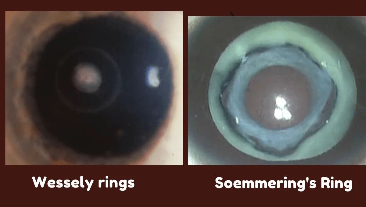 Rings in Ophthalmology - Eye Health Nepal, image size:1200x680