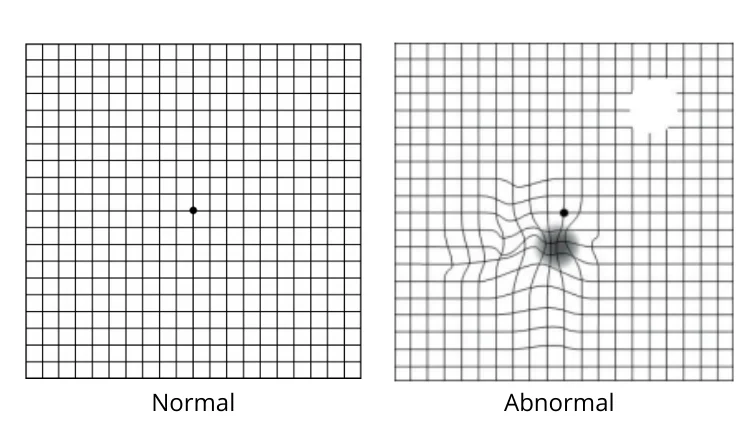 Normal vs abnormal amsler grid chart image