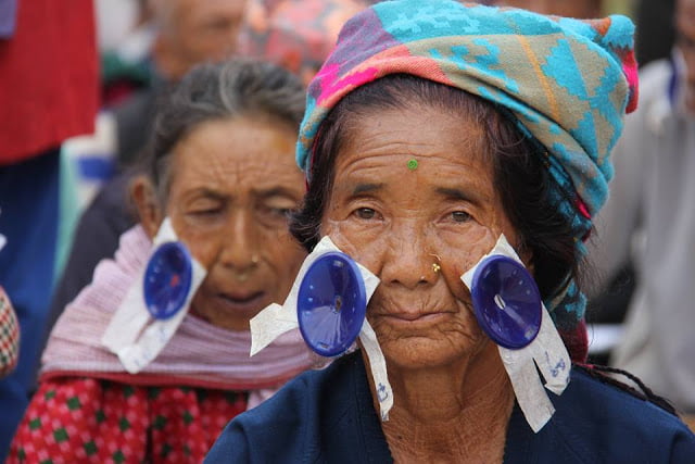 Post operative cataract patient