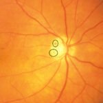Optic disc hemorrhage