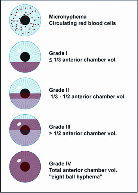 grading-of-hyphema