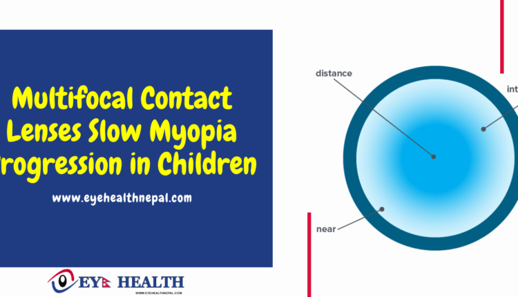 Multifocal Contact Lenses Slow Myopia Progression in Children