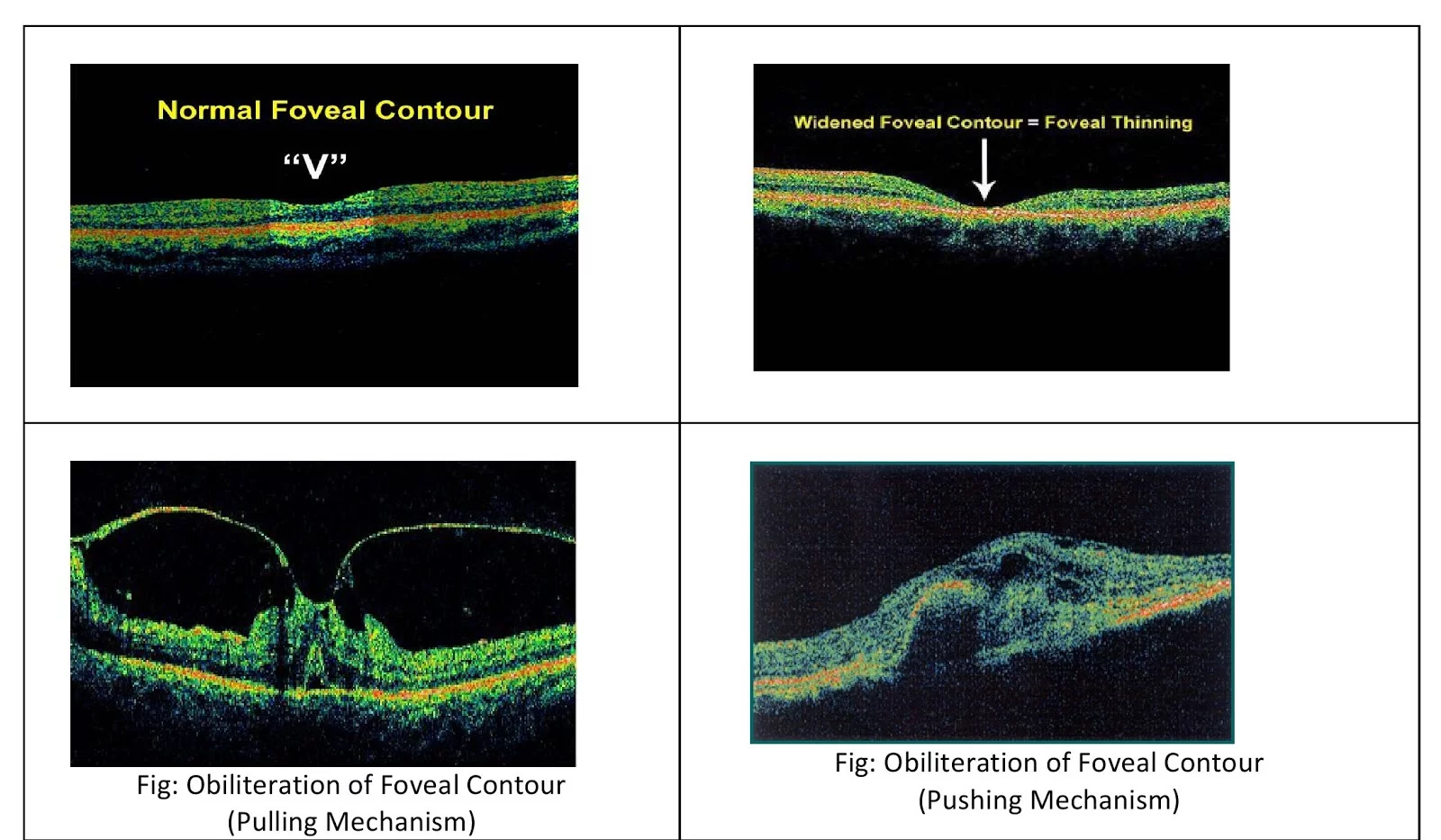 Foveal contour on OCT Scan