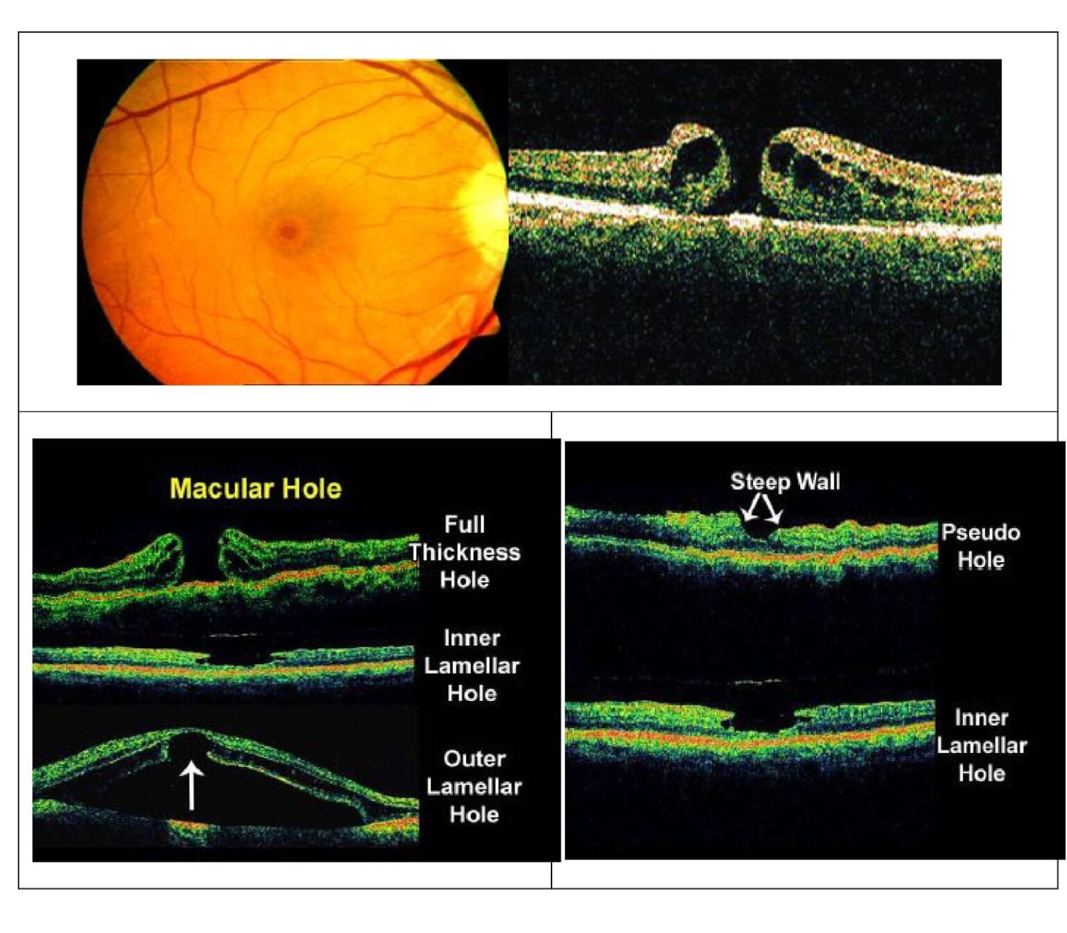What Is Optical Coherence Tomography OCT Basic Interpretation