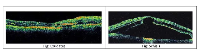How does exudates looks on Optical coherence topography oct scan
