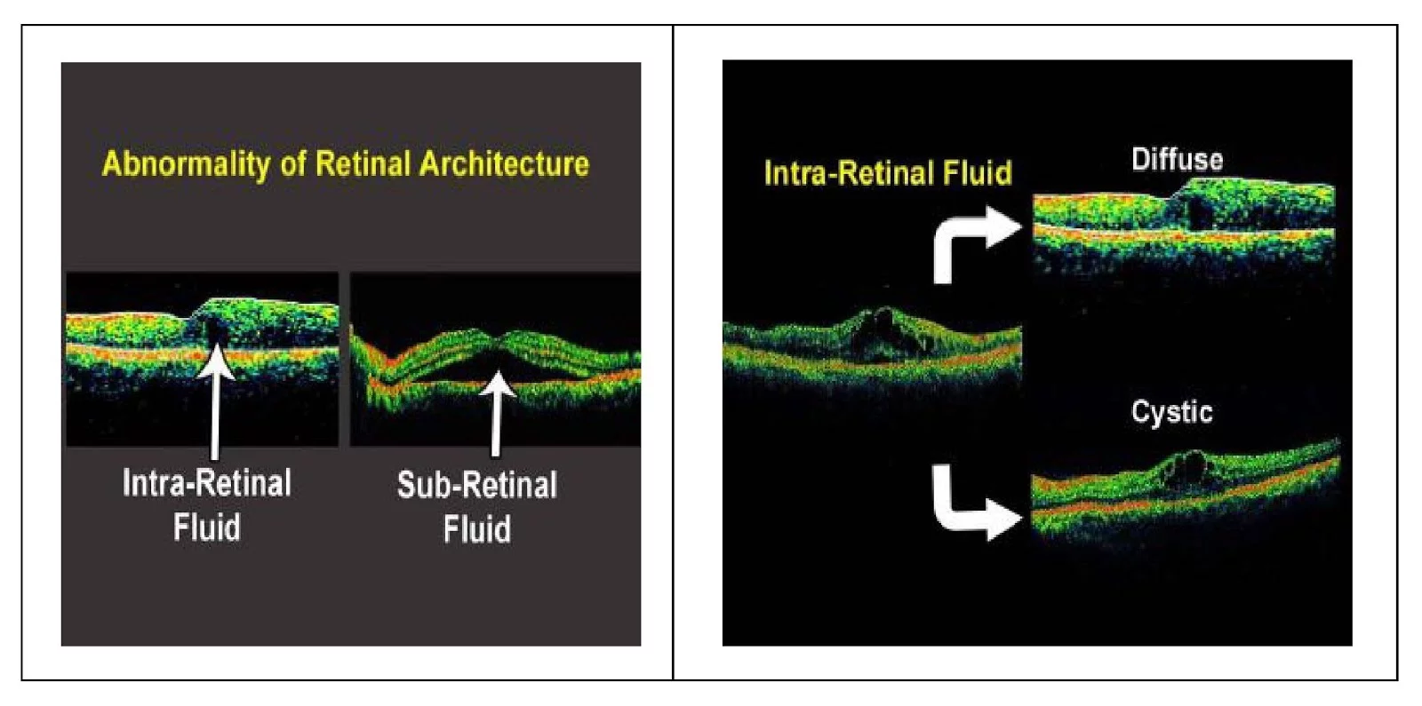Retinal architecture on OCT