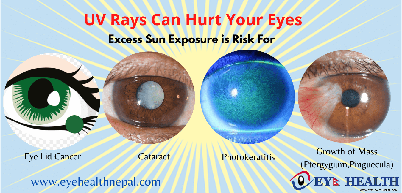 UV rays effects on eyes like cancer, cataract, photokeratitis and pterygium