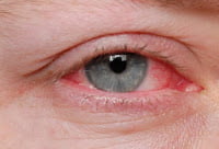 Itchy eye