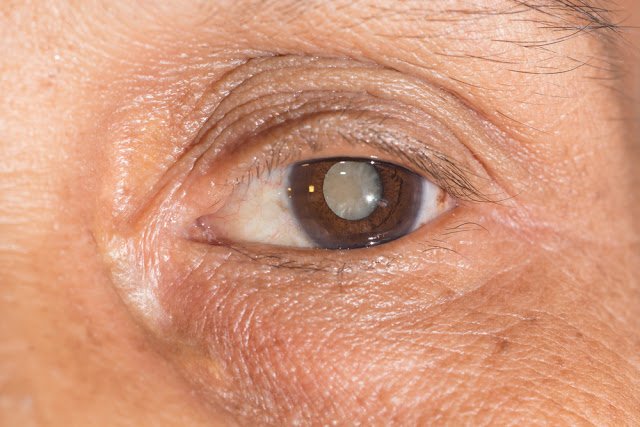 Mature cataract in the eyes