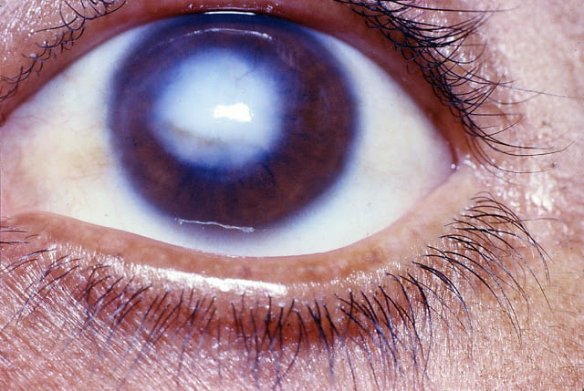 Corneal Opacity