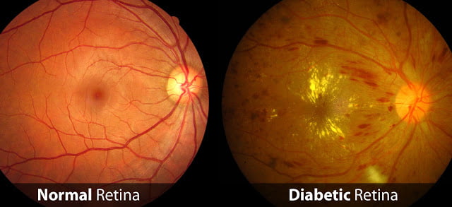 Diabetic Retina and Normal Retina Differentiation