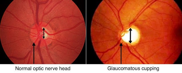 glaucoma disc cupping vs normal disc