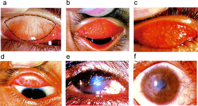 Trachoma Blinding disease grading