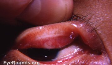 Arlts-line-trachoma