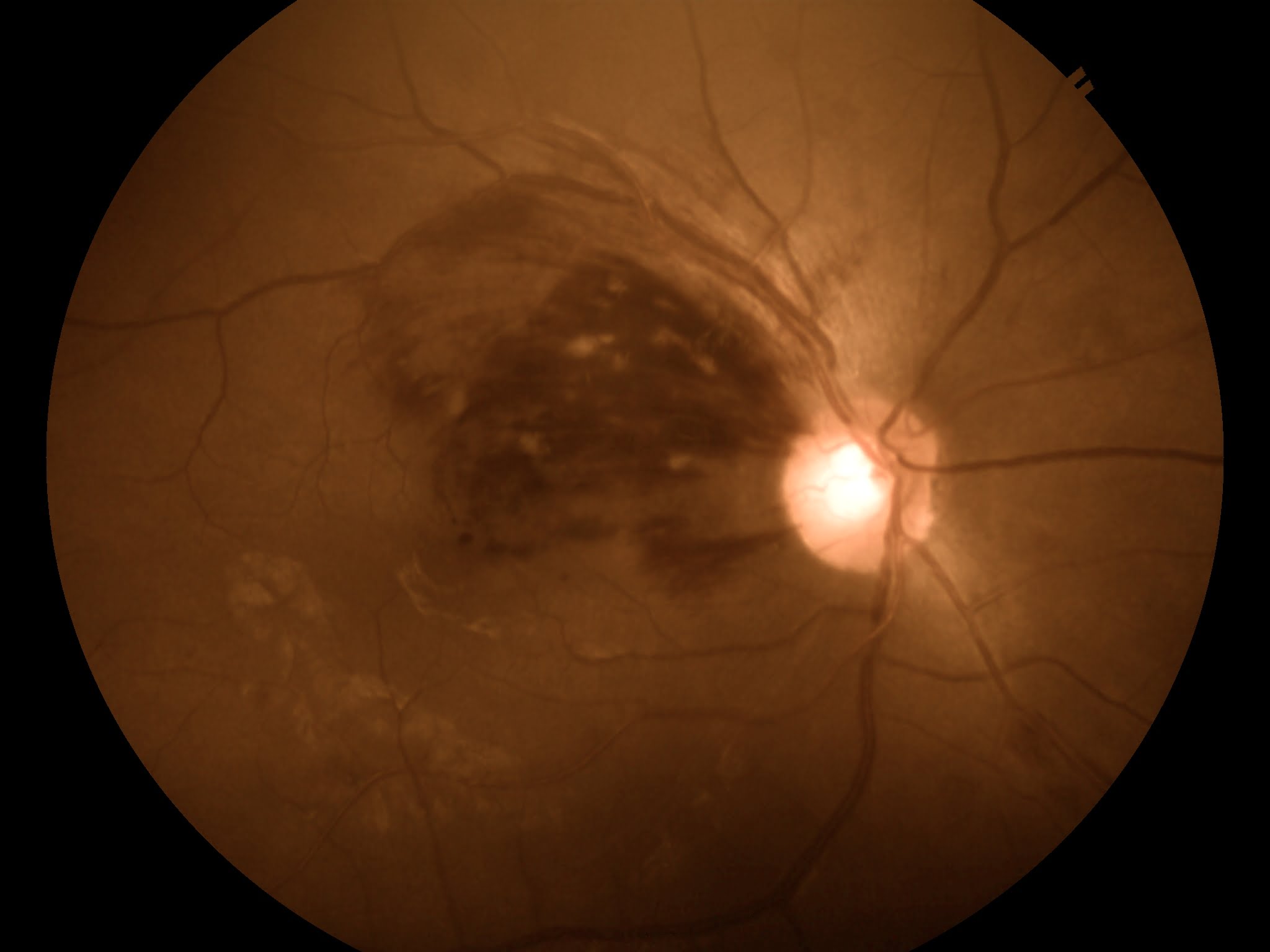 Branch Retinal Vein Occlusion (BRVO)