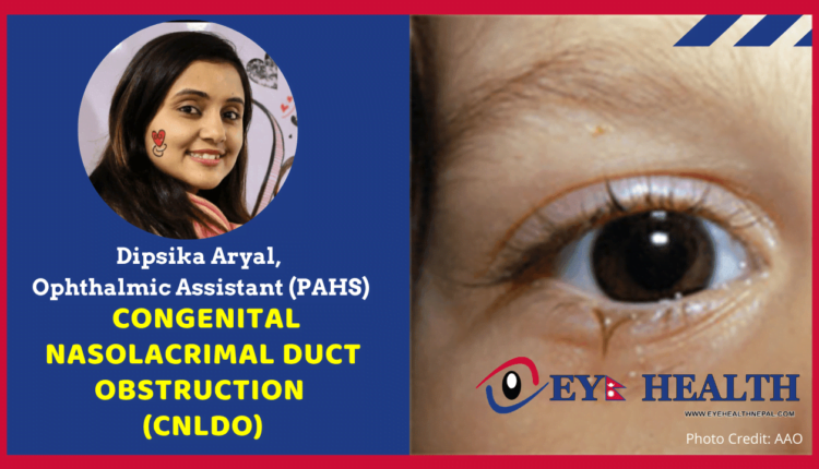 Congenital NasoLacrimal Duct Obstruction (CNLDO) cause, treatment and sac massage