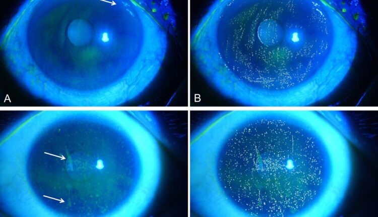 Corneal Staining with fluorescein sodium salt