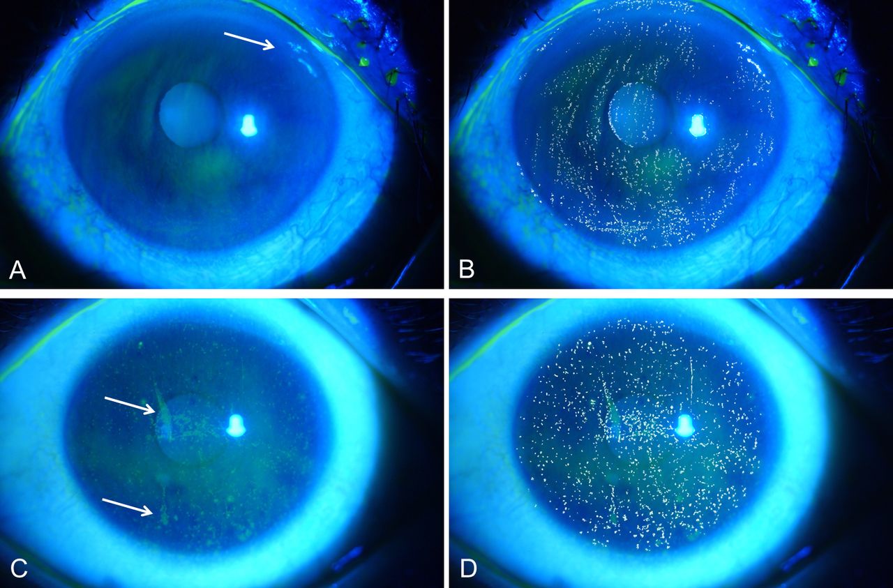 Fluorescein Sodium Strips and Fluorescein angiography Eye Health Nepal
