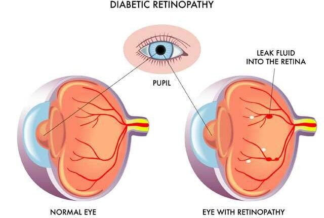 Normal vs Diabetes eye