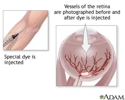 Fluorescein angiography
