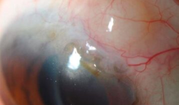 Ferry’s line is a Corneal epithelial iron line at the edge of filtering blebs of glaucoma surgery.
