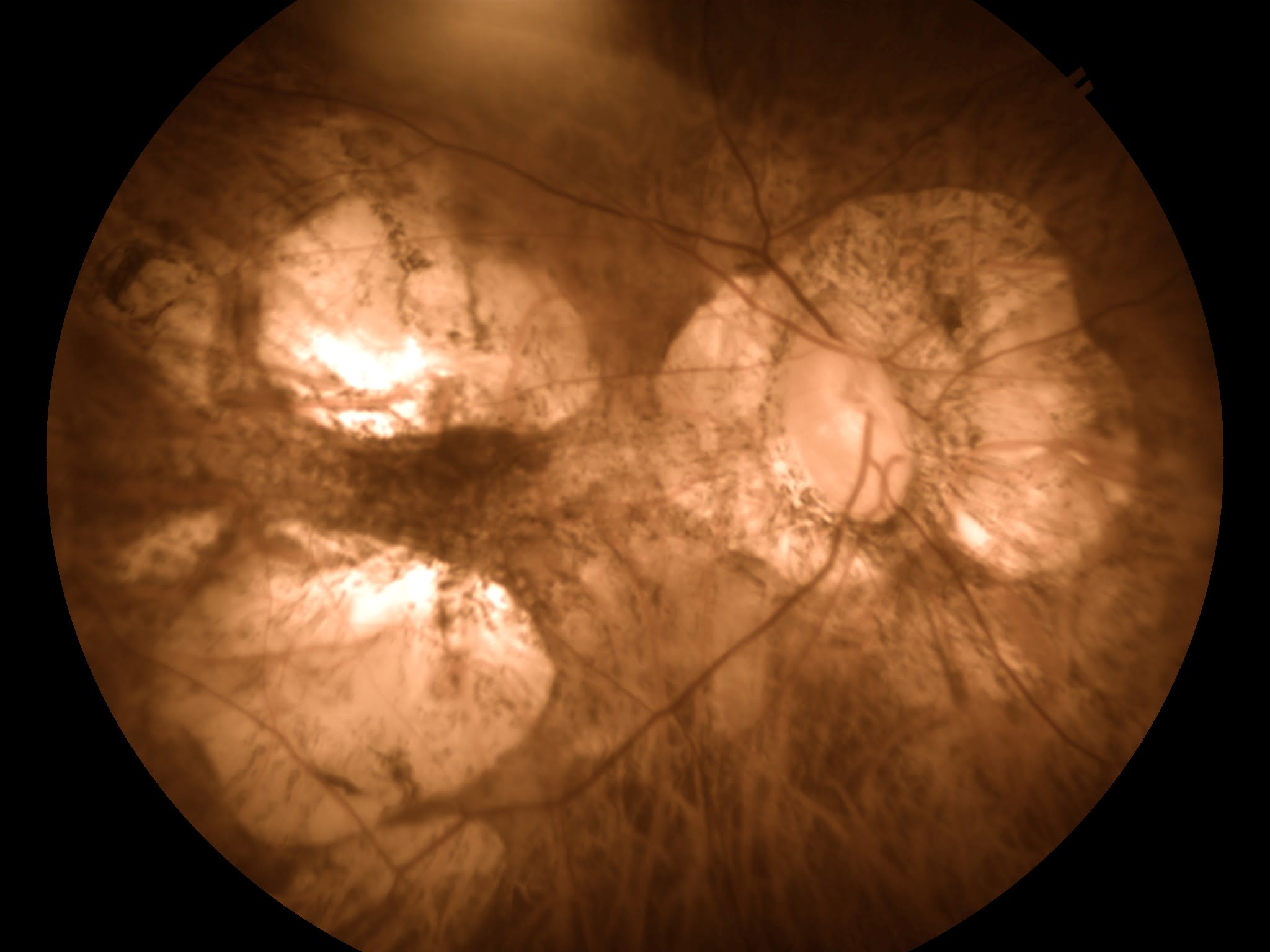 Chorio retinal atrophy fundus imaging photo