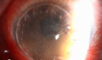 Khodadoust line of cornea seen on corneal transplant endothelial graft rehection