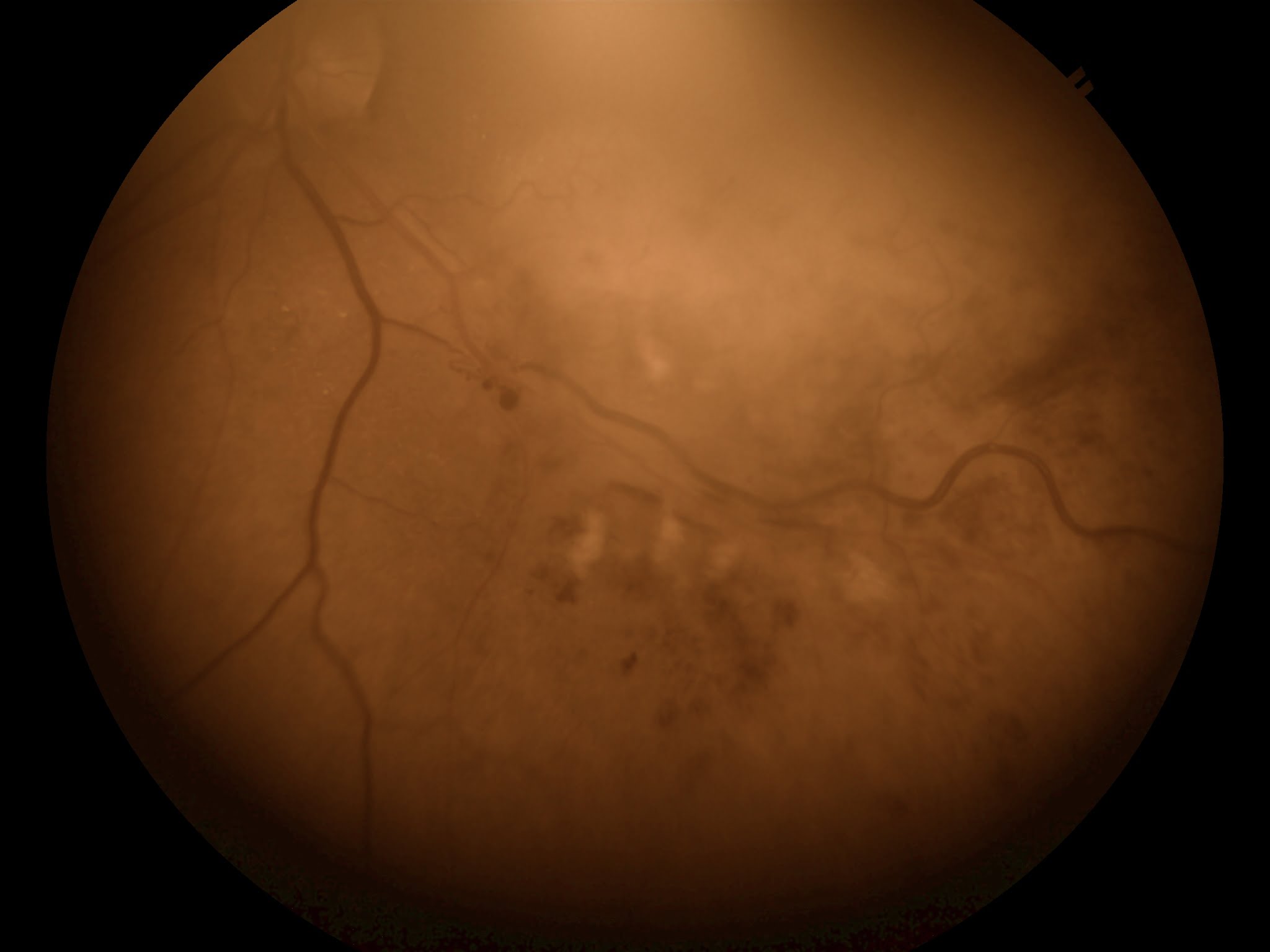 Neovascularization-on-retina