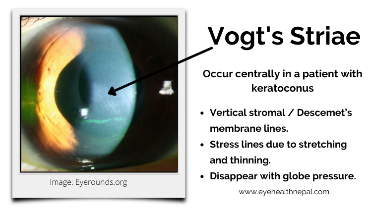 Vogt’s striae is the main sign of keratoconus