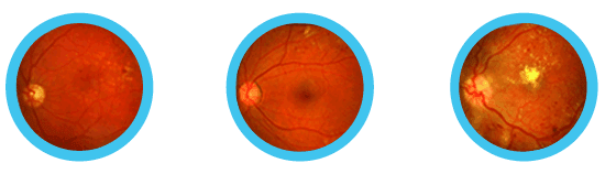 diabetic-retinopathy-grading-online