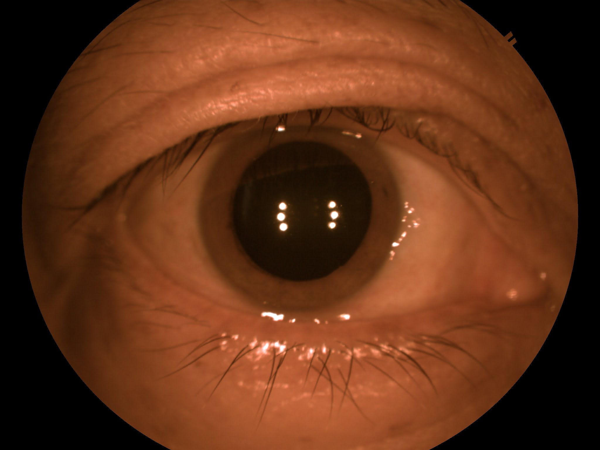 Dilated pupil after applying cycloplegic eye drop