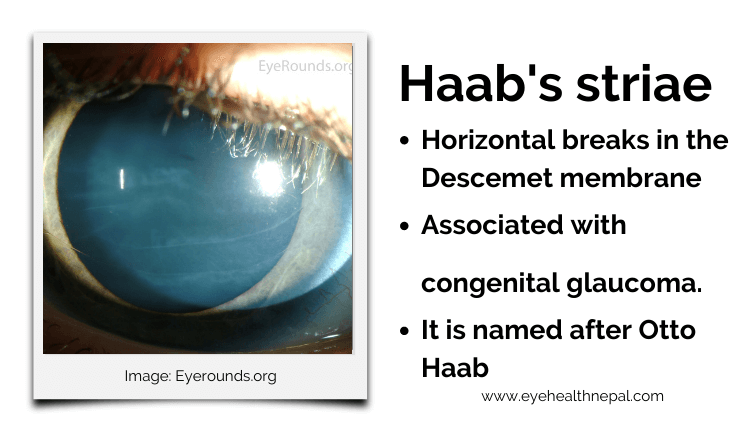 Haab's striae in primary infantile glaucoma
