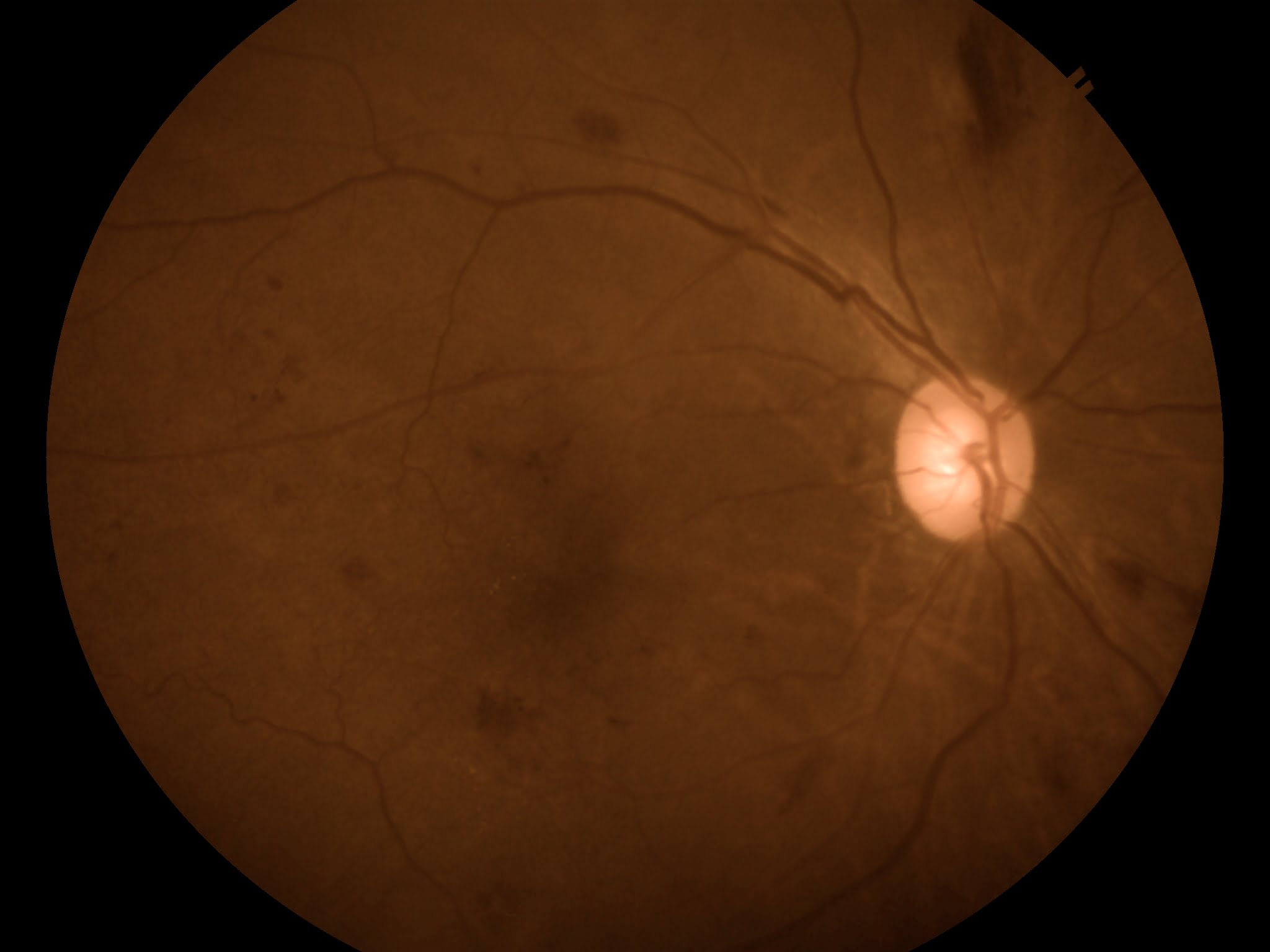 Retinal Hemorrhage seen on patient with systemic hypertension and diabetes