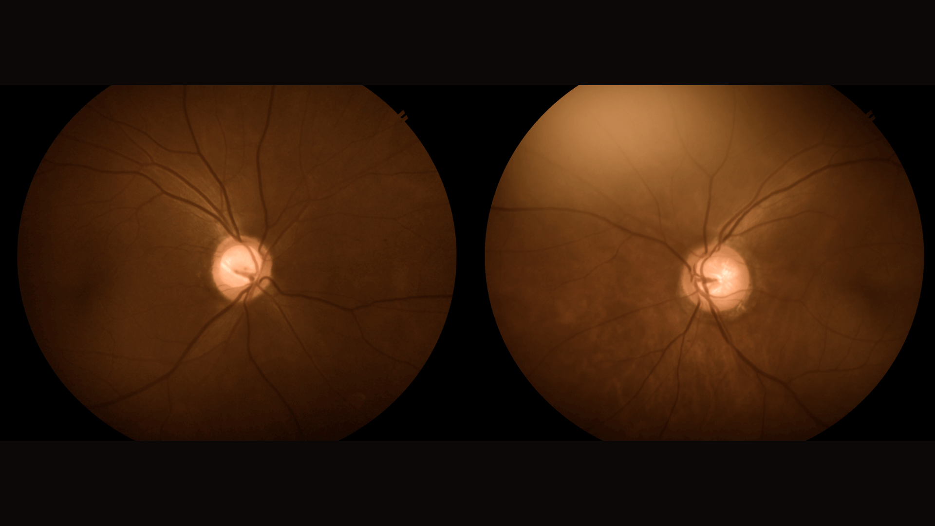 Optic disc photo showing both eyes having large cup to disc ratio on glaucoma case