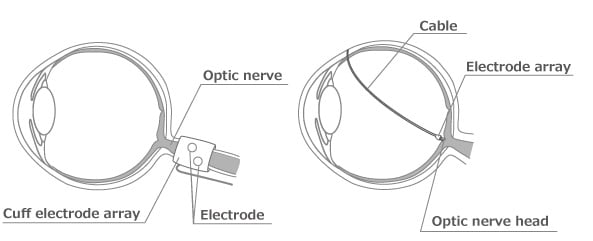 optic-nerve-implant