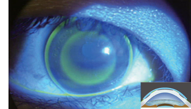 orthokeratology lenses in the cornea of an eyeball