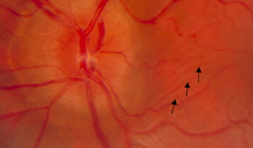 patons line seen in optic nerve head on papilledema