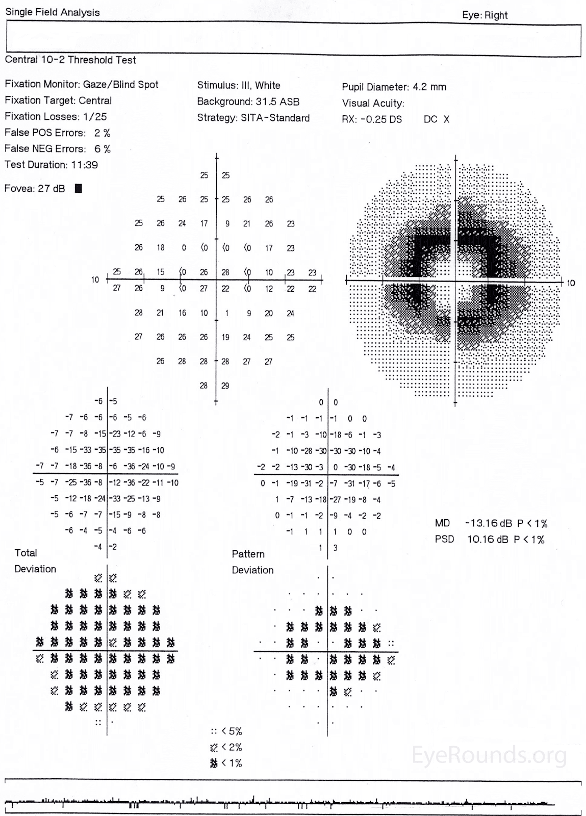 Hydroxychloroquine Retinopathy Eye Health Nepal
