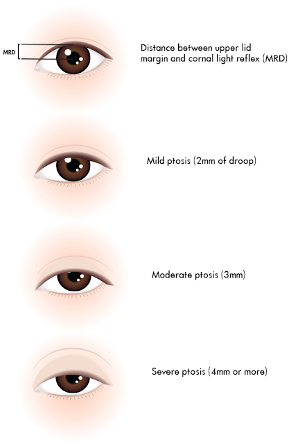 Ptosis-grading
