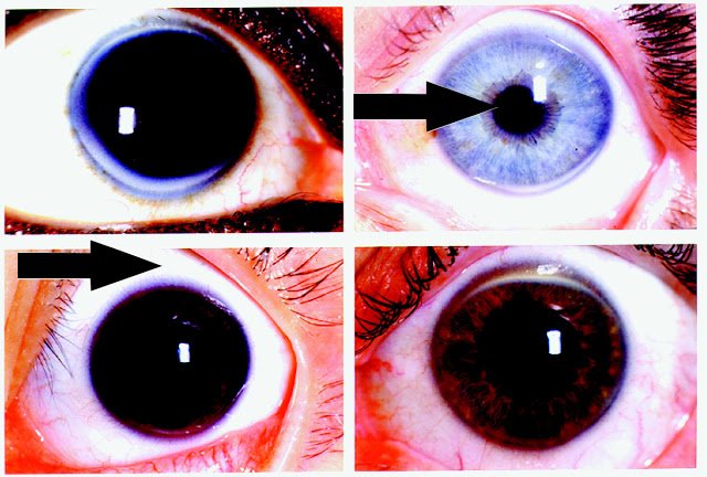 Corneal Rust Ring