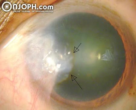 stocker line in Ophthalmology