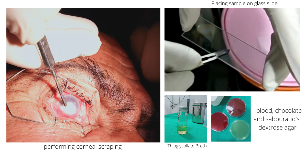 Procedure of corneal scraping, different agar and sample collection