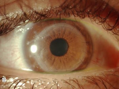After COrneal Transplant 