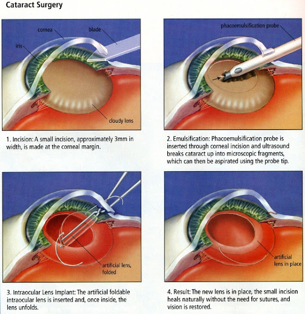 Procedure of catarct surgery