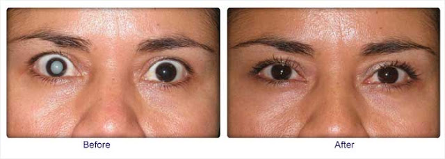 Before and After Cataract Surgery