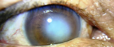 Corneal Scar